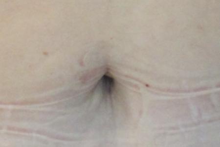 Before image 6 Case #119131 - 53 year-old Patient | Mommy Makeover