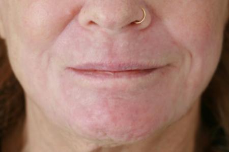 After image 1 Case #119171 - Peri-oral Co2 Laser Resurfacing