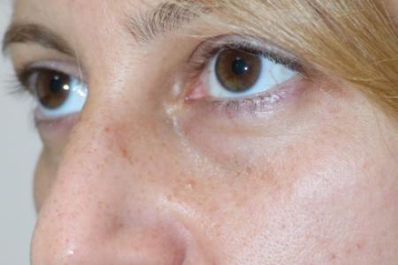 Before image 3 Case #120926 - Fat transfer to midface
