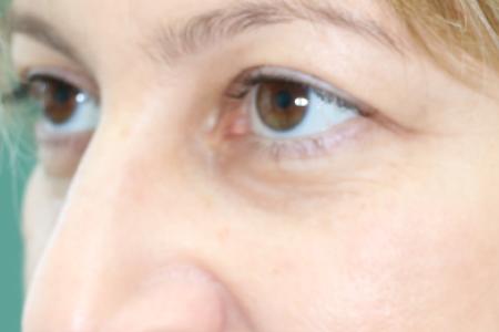 After image 3 Case #120926 - Fat transfer to midface