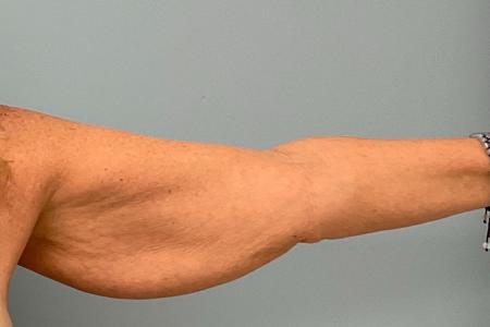 Before image 1 Case #120626 - 64 year old female with Bilateral Brachioplasty