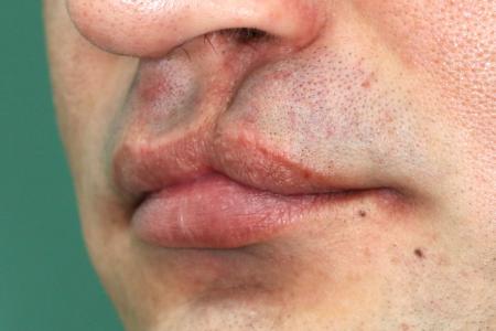 Before Case #122401 - Cleft Lip Revision