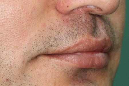 After Case #122401 - Cleft Lip Revision