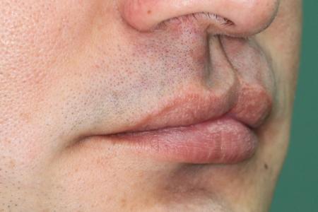 Before Case #122401 - Cleft Lip Revision
