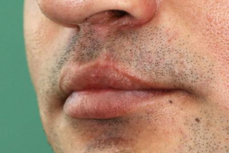 After Case #122401 - Cleft Lip Revision