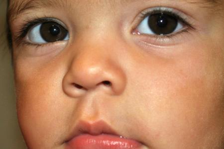 After image 2 Case #122871 - Congenital Vascular Malformation