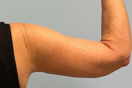After image 2 Case #123156 - 53 year old female with Arm Lift