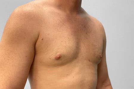 After image 2 Case #123226 - Gynecomastia Correction