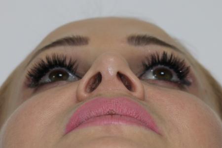 After image 4 Case #122751 - Aesthetic Reduction Rhinoseptoplasty
