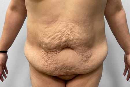 Before image 1 Case #123221 - Tummy Tuck
