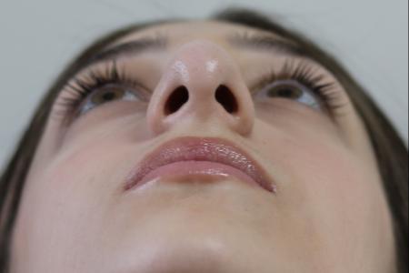 Before image 6 Case #122801 - Reduction Rhinoseptoplasty