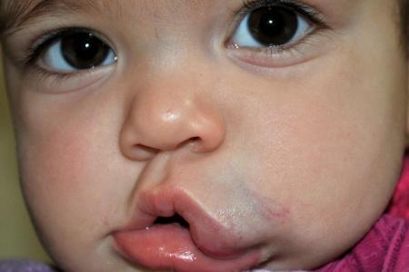 Before image 2 Case #122871 - Congenital Vascular Malformation