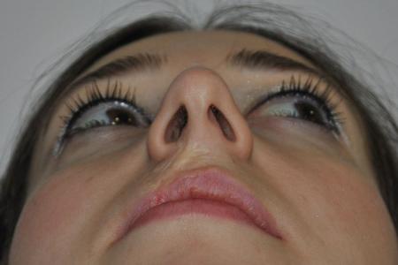 Before image 6 Case #122736 - Hybrid Rhinoplasty