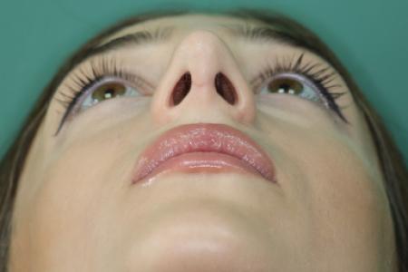 After image 6 Case #122801 - Reduction Rhinoseptoplasty