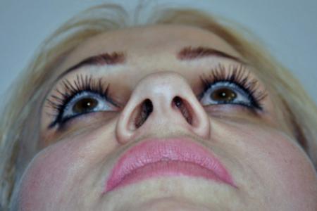 Before image 4 Case #122751 - Aesthetic Reduction Rhinoseptoplasty