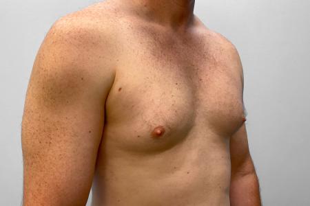 Before image 2 Case #123226 - Gynecomastia Correction