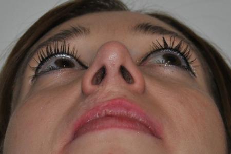 After image 6 Case #122736 - Hybrid Rhinoplasty