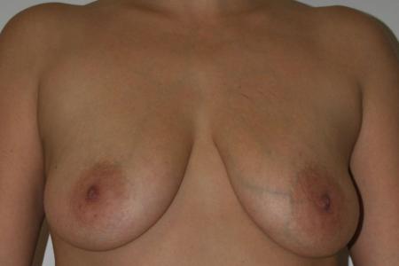 Before image 1 Case #122856 - AUTOAUGMENTATION