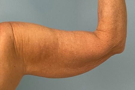 Before image 2 Case #123156 - 53 year old female with Arm Lift