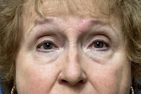 Before image 1 Case #123531 - 74 year old - Upper & Lower Bleph