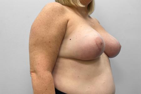 After image 2 Case #123486 - Breast Augmentation with Lift