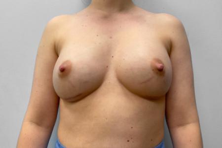 After image 1 Case #123481 - Breast Augmentation