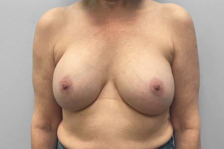 Before image 1 Case #123516 - Breast Implant Exchange