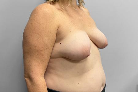 Before image 2 Case #123486 - Breast Augmentation with Lift