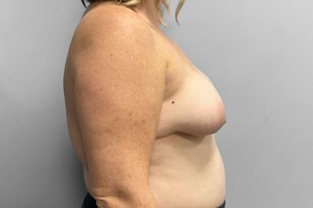 Before image 3 Case #123486 - Breast Augmentation with Lift