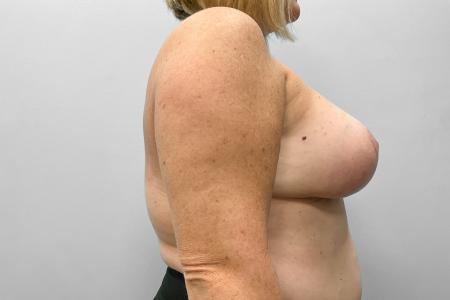 After image 3 Case #123486 - Breast Augmentation with Lift