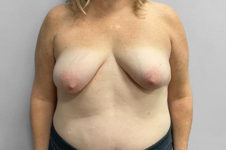 Before image 1 Case #123486 - Breast Augmentation with Lift
