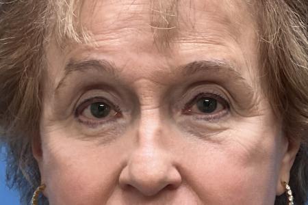 After image 1 Case #123531 - 74 year old - Upper & Lower Bleph