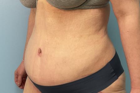 After image 2 Case #123456 - 34 year old female with an abdominoplasty