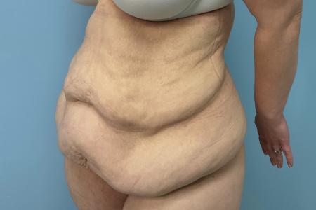 Before image 2 Case #123456 - 34 year old female with an abdominoplasty