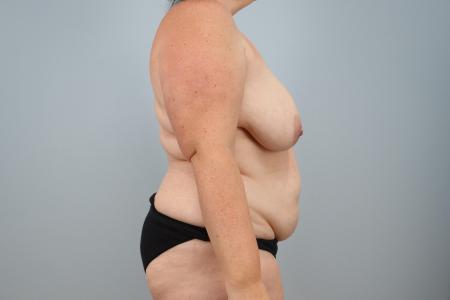 Before image 2 Case #123916 - Mommy Makeover