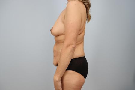 Before image 2 Case #123861 - Mommy Makeover