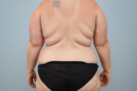 Before image 3 Case #123916 - Mommy Makeover