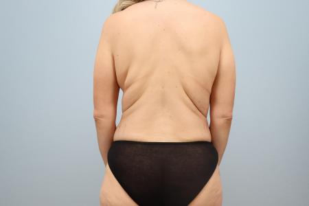 After image 3 Case #123861 - Mommy Makeover