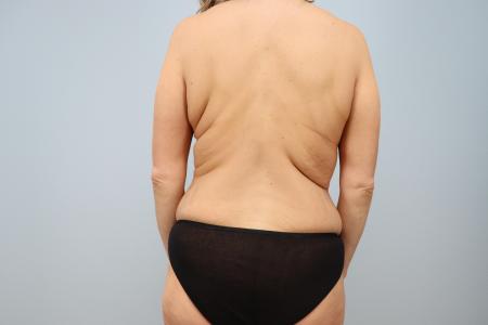 Before image 3 Case #123861 - Mommy Makeover
