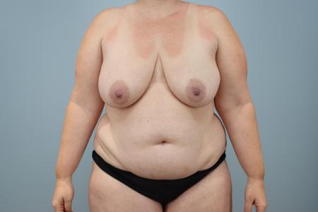 Before image 1 Case #123916 - Mommy Makeover