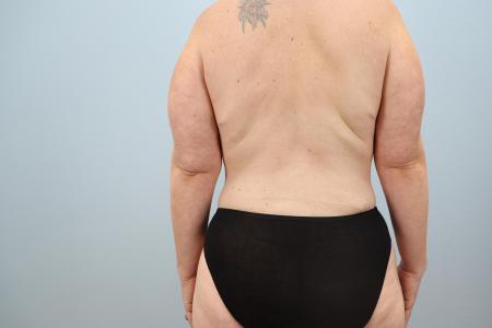 After image 3 Case #123916 - Mommy Makeover