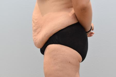 Before image 2 Case #124426 - Tummy Tuck