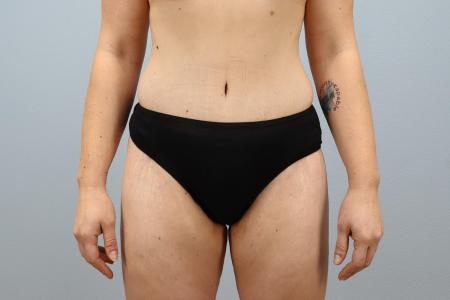 After image 1 Case #124426 - Tummy Tuck