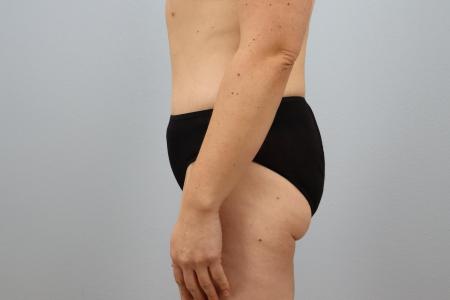 After image 2 Case #124426 - Tummy Tuck