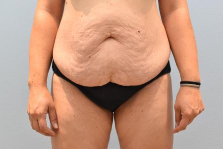 Before image 1 Case #124426 - Tummy Tuck