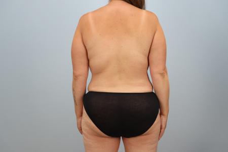 After image 3 Case #124431 - Mommy Makeover