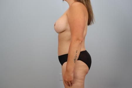 After image 2 Case #124431 - Mommy Makeover