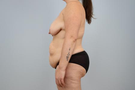 Before image 2 Case #124431 - Mommy Makeover