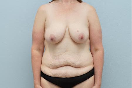 Before image 1 Case #124276 - Mommy Makeover