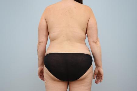 Before image 3 Case #124431 - Mommy Makeover